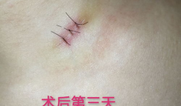 痣切除手术视频全过程,专业操作与术后护理详解